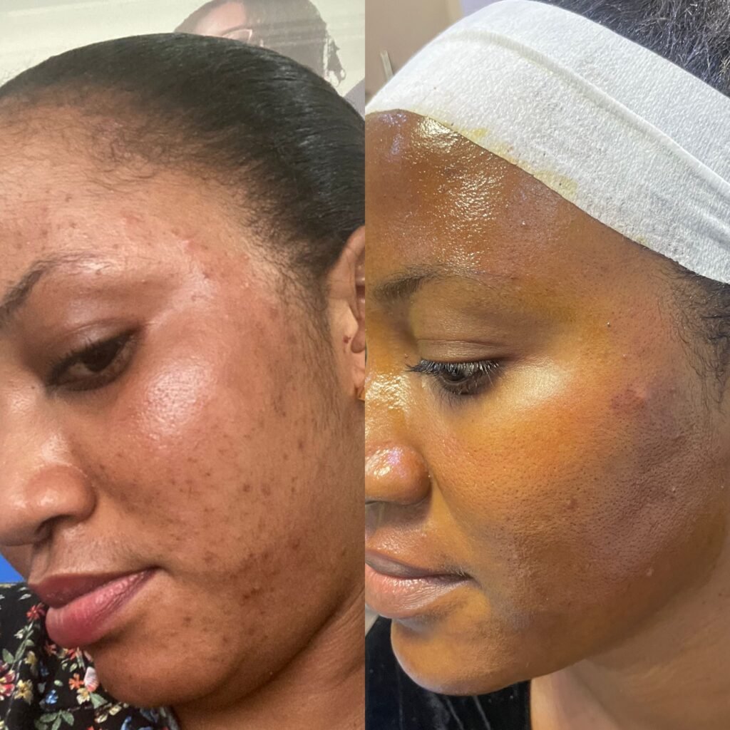 Customer skin before and after using SBS products